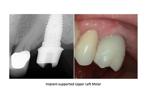Dental Implants Case Study