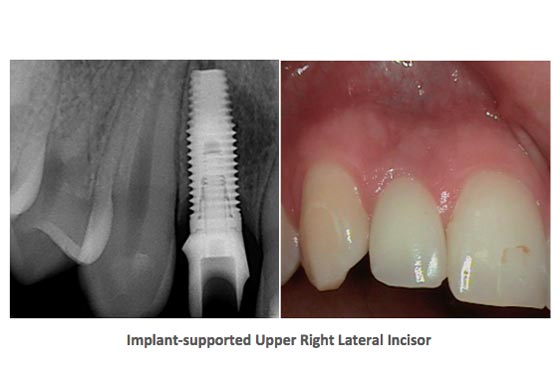 Dental Implants Case Study