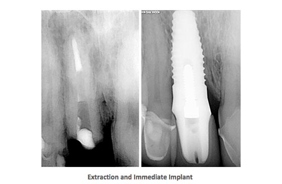 Dental Implants Case Study