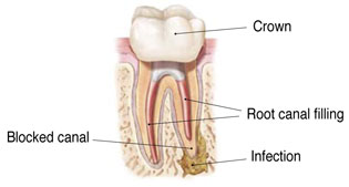 Non-Surgical Endodontic Treatment Illustration