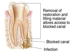 Non-Surgical Endodontic Treatment Illustration