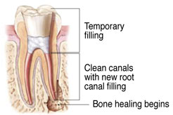 Non-Surgical Endodontic Treatment Illustration