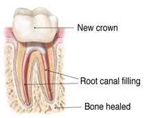 Non-Surgical Endodontic Treatment Illustration