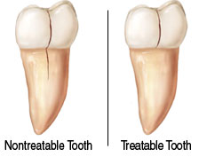 Cracked Tooth Illustration