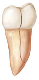 Cracked Tooth Illustration
