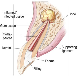 Surgical Endodontic Treatment Illustration