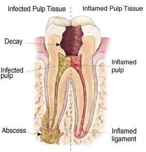 Non-Surgical Endodontic Treatment Illustration