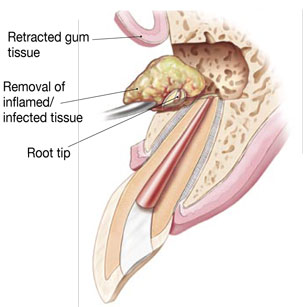 Surgical Endodontic Treatment Illustration