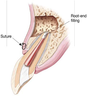 Surgical Endodontic Treatment Illustration