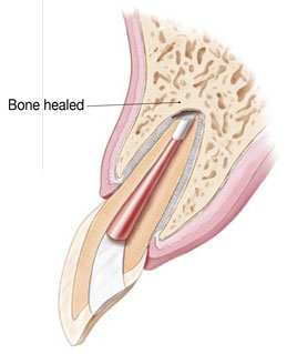 Surgical Endodontic Treatment Illustration