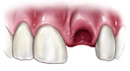 Traumatic Dental Injuries Illustration