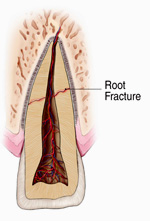 Traumatic Dental Injuries Illustration