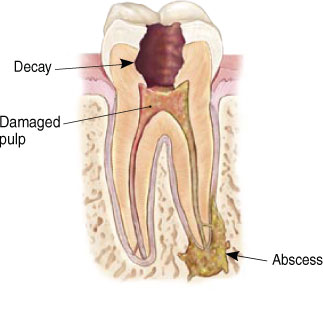 Non-Surgical Endodontic Treatment Illustration