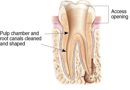 Non-Surgical Endodontic Treatment Illustration