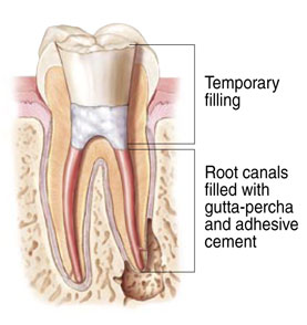 Non-Surgical Endodontic Treatment Illustration