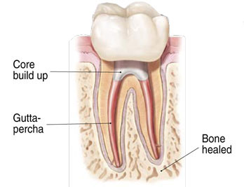 Non-Surgical Endodontic Treatment Illustration