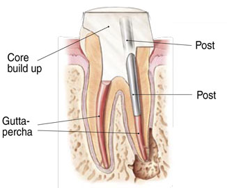 Non-Surgical Endodontic Treatment Illustration