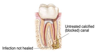 Non-Surgical Endodontic Treatment Illustration