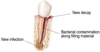 Non-Surgical Endodontic Treatment Illustration
